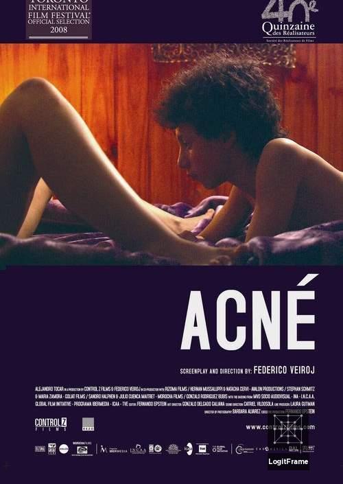 Acné (Acne)